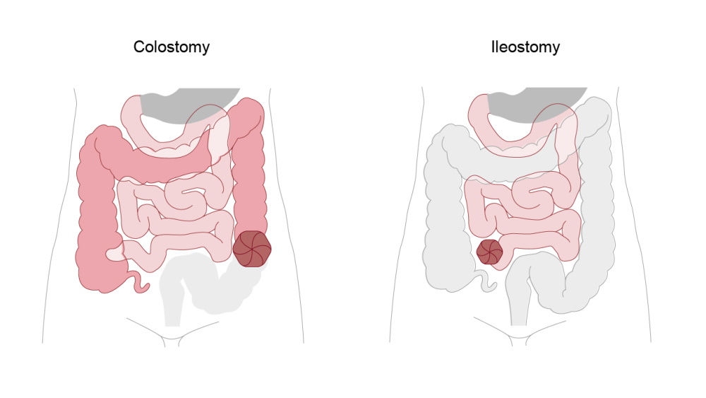 Comparação lado a lado entre uma colostomia e uma ileostomia. O diagrama da colostomia destaca o intestino grosso (cólon) em rosa, com um estoma na parte inferior do abdômen. O diagrama da ileostomia destaca o intestino delgado (íleo) em rosa, também com um estoma na parte inferior do abdômen.