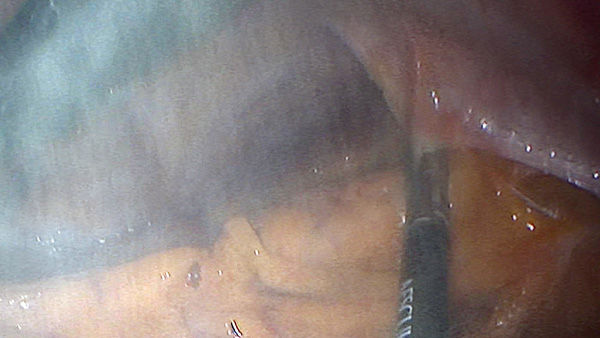 EinsteinVision® em cirurgia laparoscópica com redução de fumaça