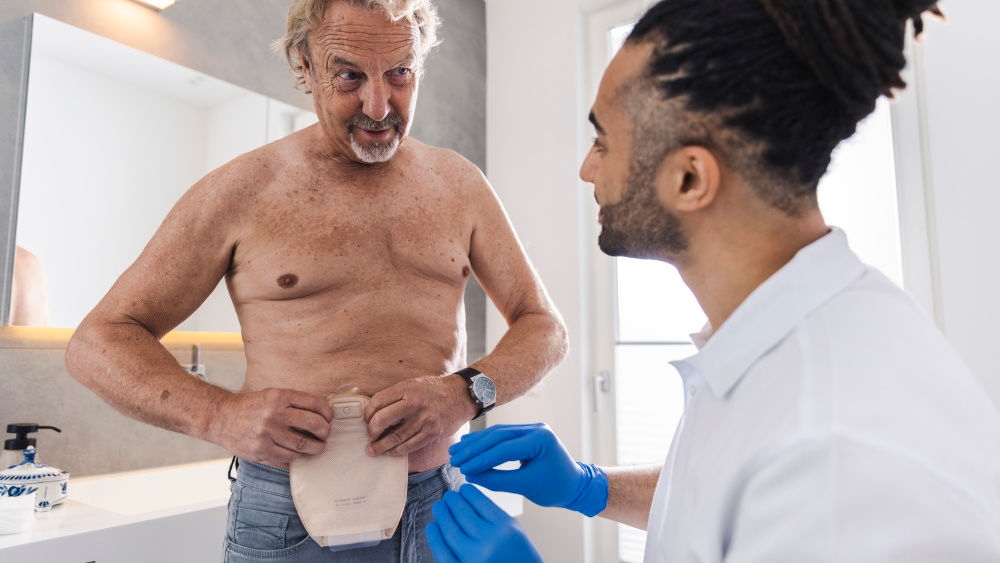 Homem com bolsa de estoma na parte superior do corpo nu, com enfermeiro usando luvas indicando como aplicar a bolsa