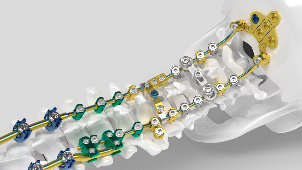 Módulo cirúrgico de Ennovate® Cervical