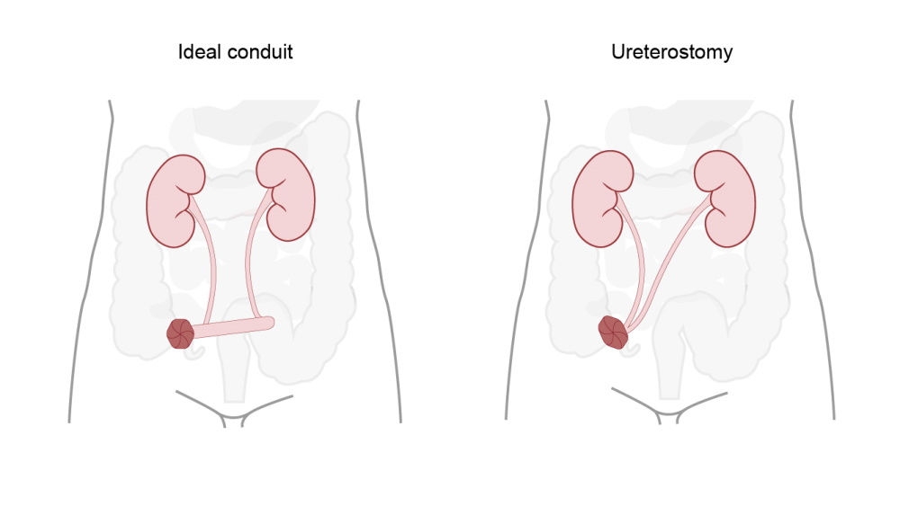 ilustração de conduto ileal e ureterostomia