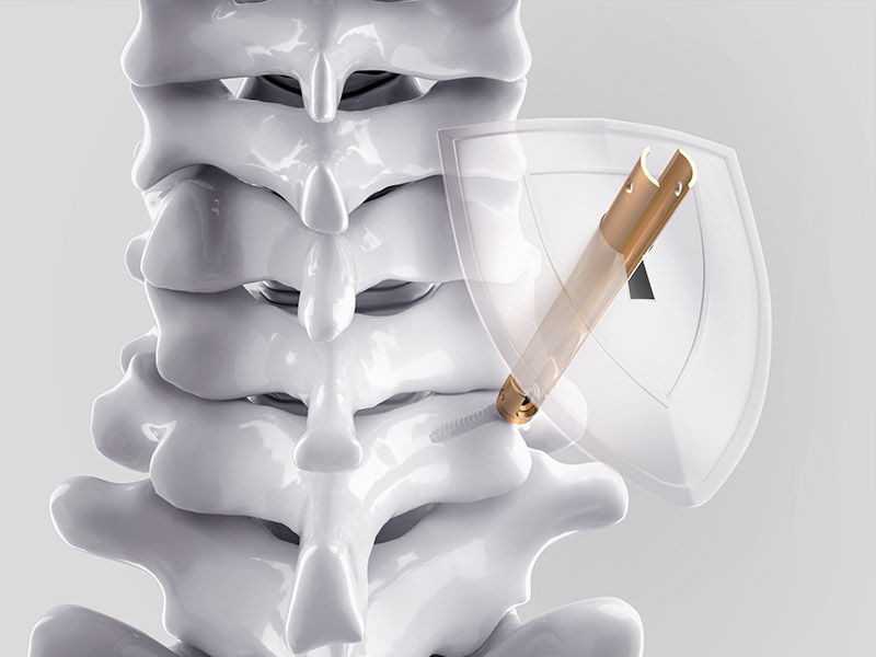 Ennovate® Cervical MIS – Intervenção mínima. Proteção aprimorada.