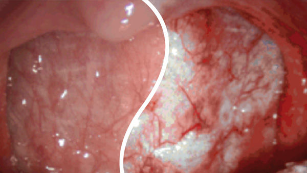 EinsteinVision® em cirurgia laparoscópica com realce vermelho