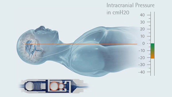 Gráfico da pressão intracraniana na posição horizontal