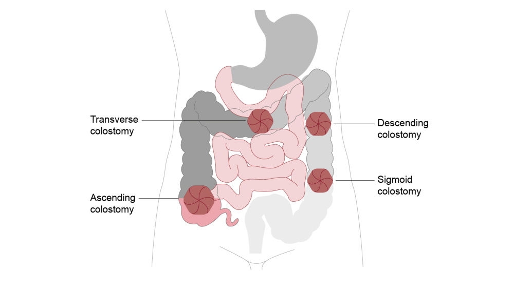 ilustração de colostomia transversa, descendente, ascendente e sigmóide