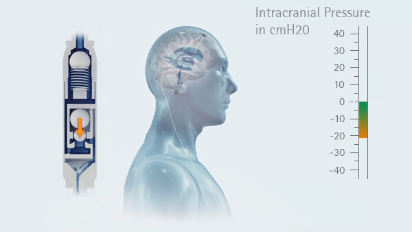 Gráfico da pressão intracraniana na posição vertical