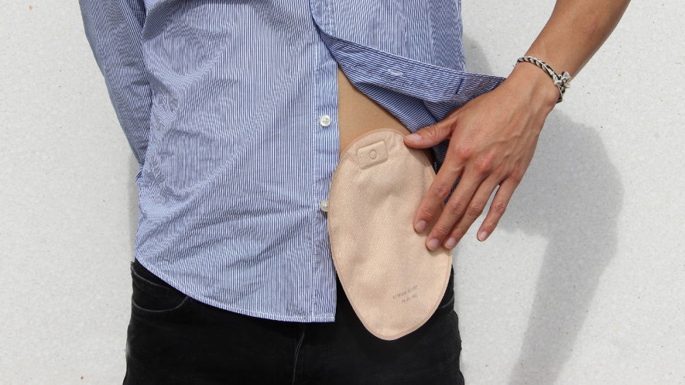 homem com camisa azul colocando a mão em sua bolsa de estoma