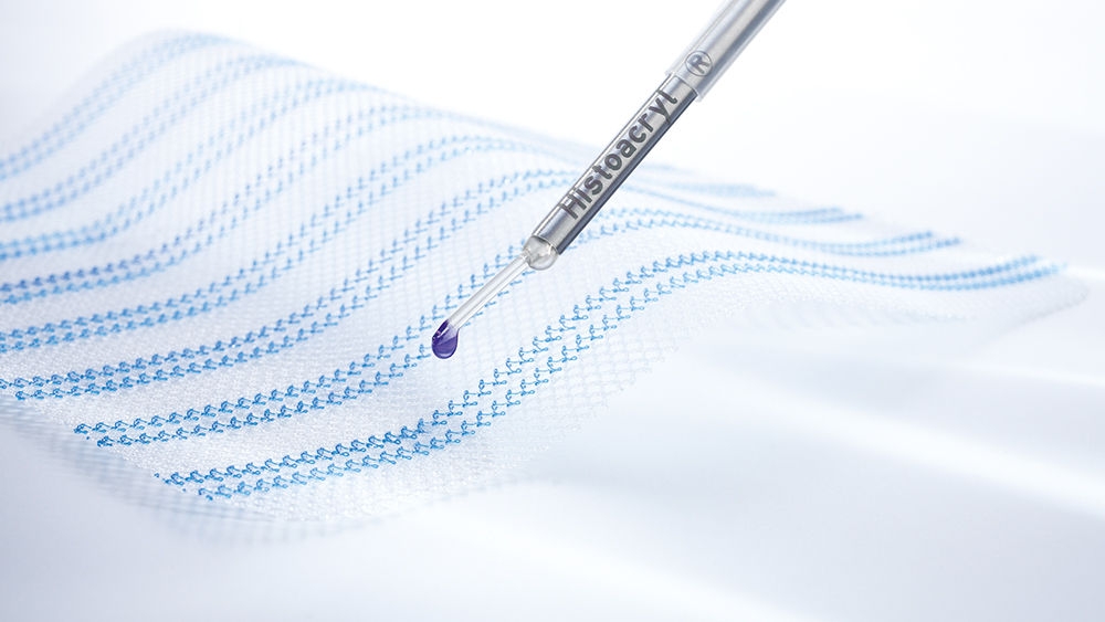 Malha cirúrgica com o aplicador Histoacryl® LapFix para fixação da malha
