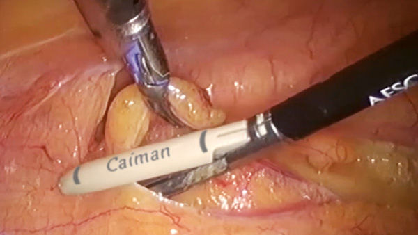 EinsteinVision® em cirurgia laparoscópica com efeito de foco automático
