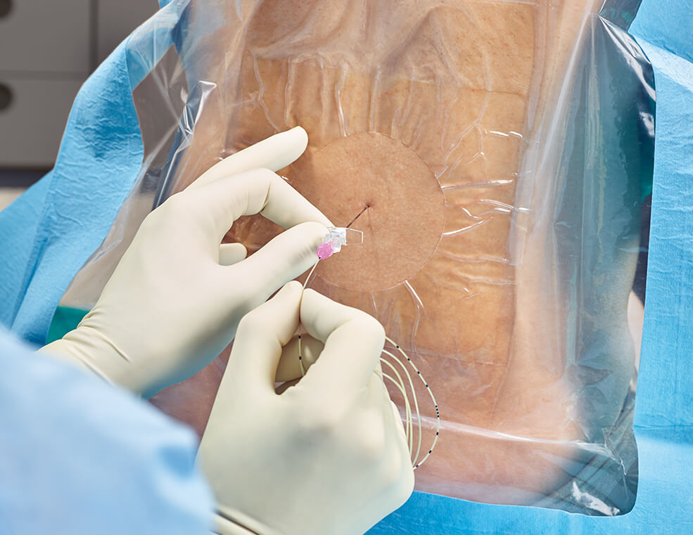 Mãos enluvadas realizando um procedimento epidural, com inserção de uma agulha e de um cateter através de um campo estéril na região dorsal do paciente