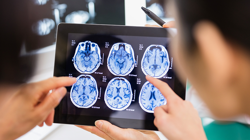 Médicos examinam uma imagem de RM do cérebro
