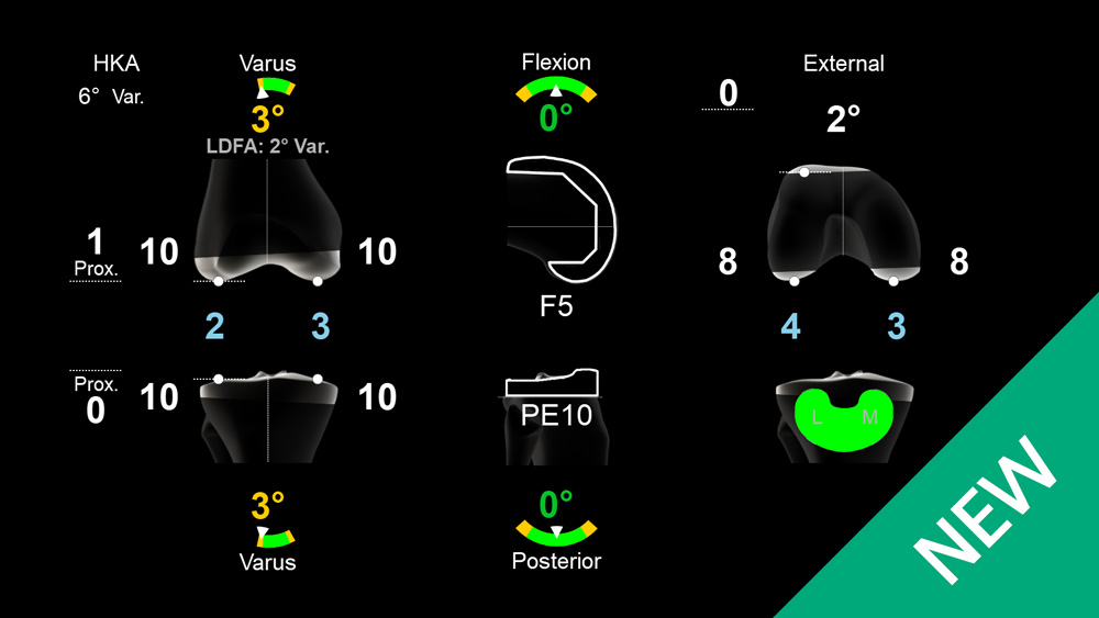 Tela do software de navegação OrthoPilot Elite Pheno4U TKA Nível 1
