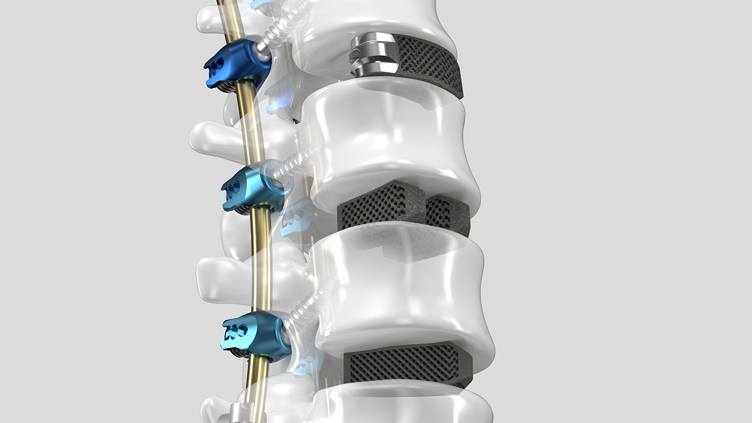 Modelo da coluna com dispositivos de fusão intercorporal impressos em 3D