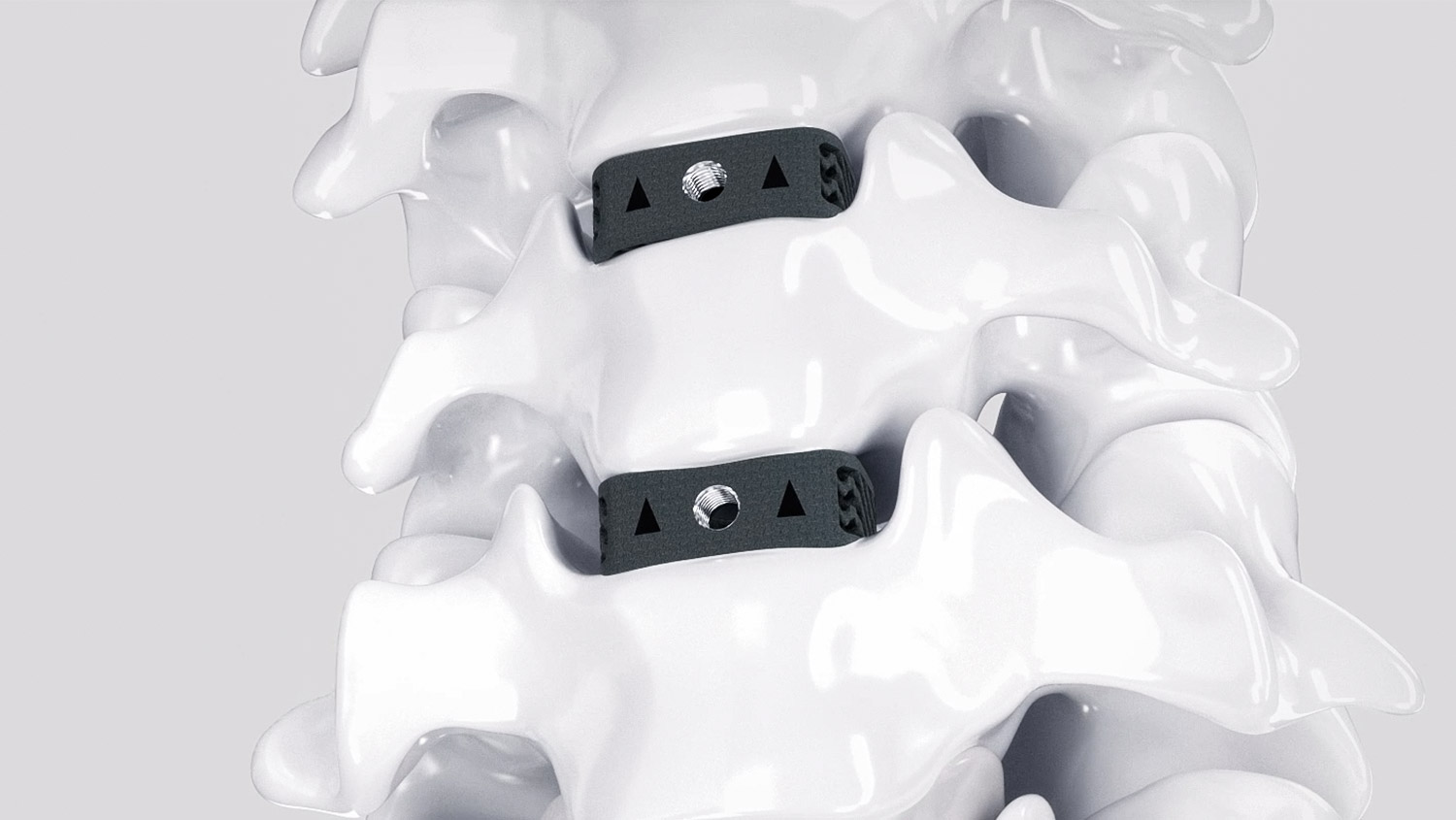 Dispositivo de fusão intercorporal cervical impresso em 3D