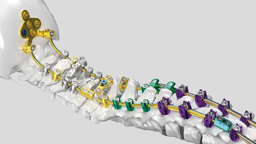 Modelo da coluna com Ennovate® Cervical